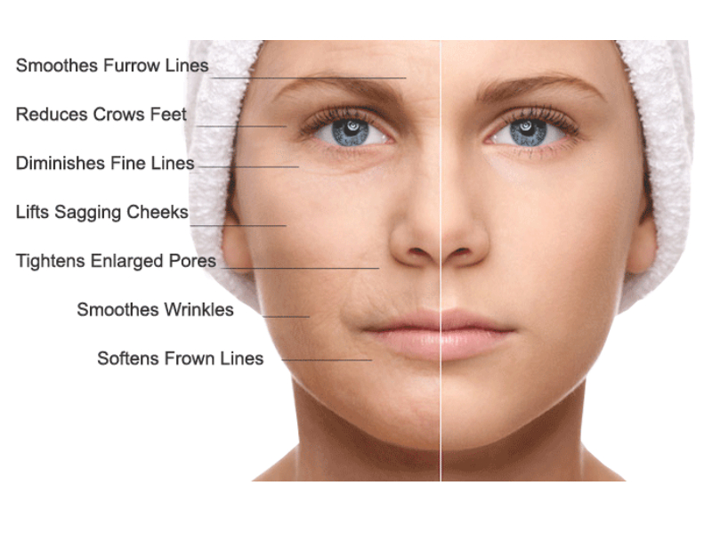 Benefits of Microneedling Treatment